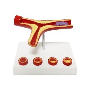 Modelo de Aterosclerosis y Trombosis Humana KyrenMed, Modelo Cardiovascular de Aterosclerosis Ampliado 10 Veces - Product Image 1