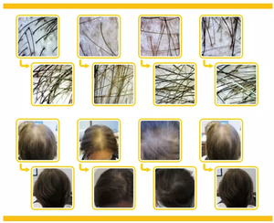 Máquina Portátil de Regeneración Activa del Cabello con Láser de Diodo de 650nm, Terapia de Oxígeno PDT para el Crecimiento del Cabello - Product Image 6