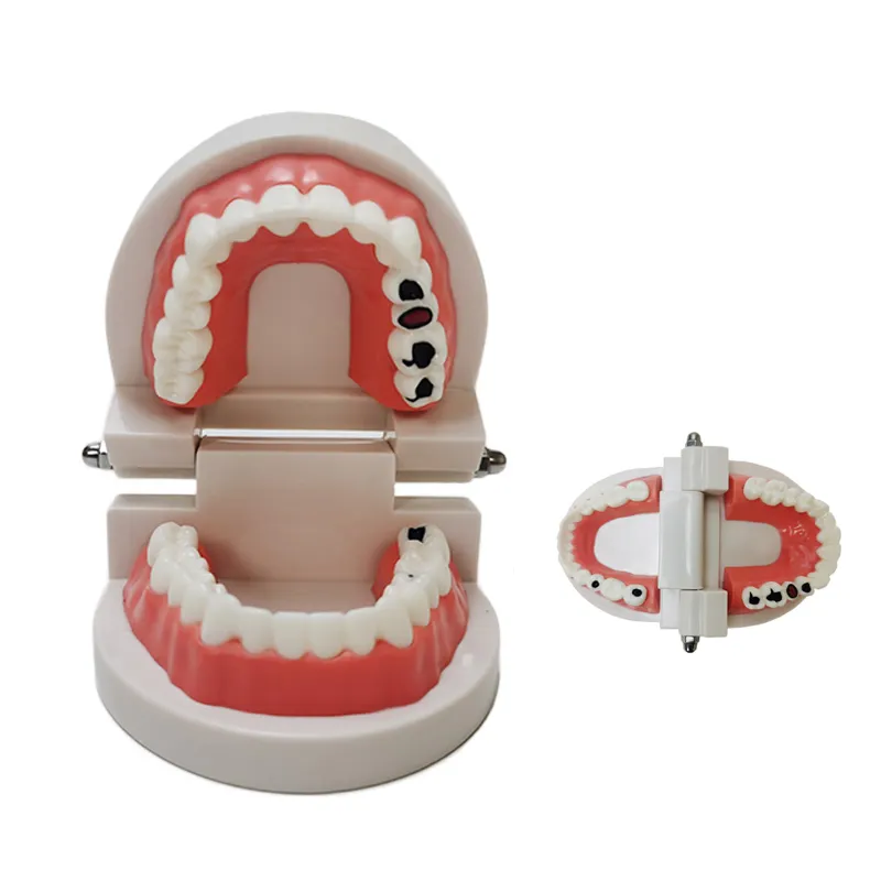 dental model 1:1 Child Kids Tooth decay Teeth Model for educational model hygiene