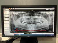 Appareil de radiographie panoramique dentaire électrique 3D PAPAYA Plus Pano Ceph CBCT d'occasion