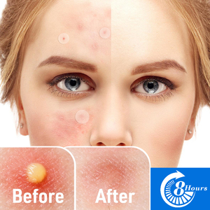 Miếng dán trị mụn Hydrocolloid Master, điều trị mụn tại chỗ, 24 miếng - Product Image 3