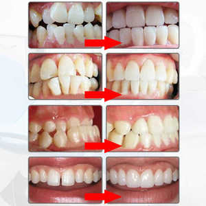 Nuevos Accesorios para Blanqueamiento Dental, <span class=keywords><strong>Alineadores</strong></span> de <span class=keywords><strong>Dientes</strong></span> para Uso Doméstico, para Entrenamiento de Ortodoncia, TPU/TPE Ecológico - Product Image 6