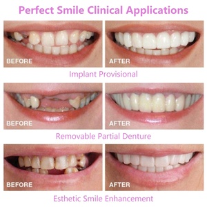 Vente chaude sourire parfait accolades encliquetables facettes dentaires pour l'enseignement et accolades temporaires couvrent les dents imparfaites - Product Image 3