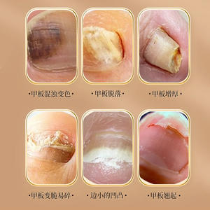 Solución OEM para el Tratamiento de Onicomicosis, Cuidado Antibacteriano de Uñas para Manos y Pies, Reparación de Daños, Especificaciones Normales - Product Image 3