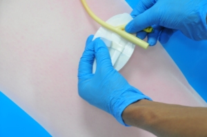 सतह कैथेटर फिक्सिंग उपकरण एंटी-बैक्टीरियल इंडीवालिंग सुई तय स्टिकर - Product Image 4