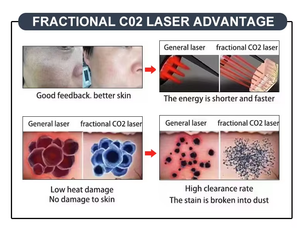 เครื่องเลเซอร์ CO2 แบบเศษส่วนสำหรับการฟื้นฟูผิวเพื่อการไวท์เทนนิ่งและกำจัดกระ พร้อมอุปกรณ์ตัดด้วยหลอดแก้ว - Product Image 3