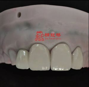 Dentaduras postizas totalmente cerámicas Zirconia o dentaduras postizas Pfm Tipos de Diseño Digital en <span class=keywords><strong>Exocad</strong></span> Rápido y eficiente - Product Image 6