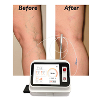 Appareil portable d'ablation laser endoveineux (EVLT/EVLA) à diode laser Vascular L Ser 980nm 1470nm