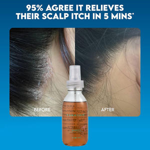 Traitement rapide du démangeaisons du cuir chevelu sec, spray hydratant pour le cuir chevelu, traitement rafraîchissant des démangeaisons du cuir chevelu pour les peaux sensibles et le <span class=keywords><strong>psoriasis</strong></span> - Product Image 1