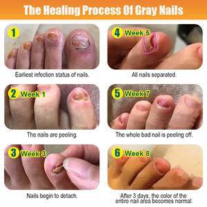 Kanyehb การรักษาเชื้อรา/ยาขัดเล็บกำจัดสีเทาขนข้ามชายแดนการค้าต่างประเทศ - Product Image 4