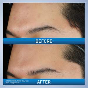 โฟมล้างหน้าและผิวกายสูตรรักษาสิว 100% ผสมเบนโซอิลเปอร์ออกไซด์ 10% พร้อมไฮยาลูรอนิค แอซิด และไนอะซินาไมด์ - Product Image 5