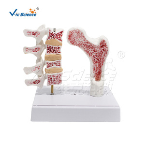Modèle d'ostéoporose VIC-V45 (2 parties), modèle de maladie, modèle d'anatomie squelettique de la colonne vertébrale humaine - Product Image 1