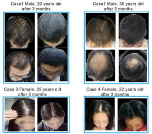 Système de croissance capillaire au <span class=keywords><strong>laser</strong></span> de qualité médicale, instruments de greffe de cheveux, traitement de la perte de cheveux au <span class=keywords><strong>laser</strong></span> 650 nm, machine de beauté à vendre - Product Image 6