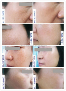 Sincoheren profesional <span class=keywords><strong>IPL</strong></span> Depilación Láser OPT <span class=keywords><strong>IPL</strong></span> Brown Spots Removal Equipment Cuidado DE LA PIEL <span class=keywords><strong>IPL</strong></span> - Product Image 5