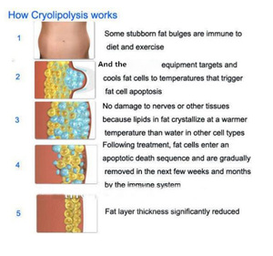<span class=keywords><strong>Machine</strong></span> de <span class=keywords><strong>cryolipolyse</strong></span> 360° sans taxes pour l'amincissement corporel et la perte de poids, technologie de congélation pour la combustion des graisses et le rajeunissement de la peau - Product Image 3