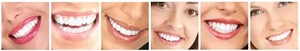 Lámpara Blanqueadora Dental Profesional de 40W para Uso en Salones y Clínicas, Acelerador de Blanqueamiento con Luz - Product Image 6