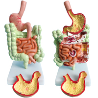 Modelo patológico de intestino grueso, lesiones gastrointestinales, modelo anatómico, enfermedad intestinal, modelo de lesiones de colon humano