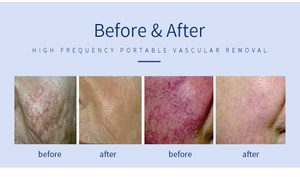 Tần số cao đông máu nhiệt mạch máu máy mạch máu <span class=keywords><strong>rbs</strong></span> Spider tĩnh mạch máy loại Bỏ Nhà Máy Giá - Product Image 4