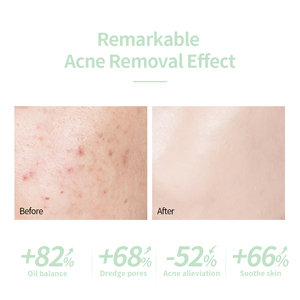 Crème Anti-Acné Réparatrice Efficace et Rapide pour une Peau Lisse, Réduit les Pores, Élimine les Cicatrices, Points Noirs et Taches - Product Image 5