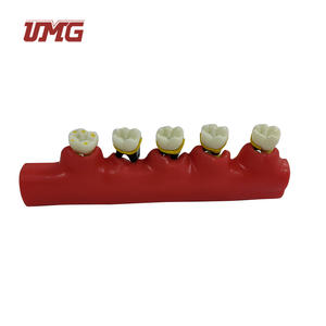 Tandheelkundige Studiemodellen Classificatiemodel Parodontitis - Product Image 4