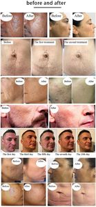 2025 Tixel 400 도 열 주름 안료 제거 기계 얼굴 피부 회춘 여드름 흉터 제거 신체 얼굴을 대상으로 - Product Image 4