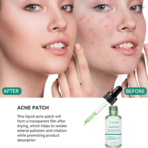 Suero Facial Antiacné y Aclarante de Fabricante OEM ODM, Niacinamida, Ácido Salicílico, Suero Calmante para el Cuidado de la Piel con Acné - Product Image 4