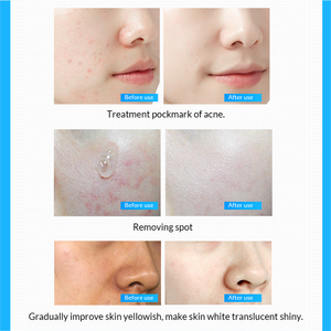 Meilleure vente de marque omy lady vegan soins de la peau visage anti-âge et hydratant microneedling sérum de corée - Product Image 5