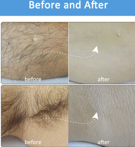 Láser de diodo permanente de 808nm para depilación de todos los colores de piel con 3 longitudes de onda 808nm 755nm 1064nm - Product Image 6