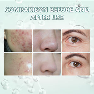 מכשיר יופי אסתטי חדש דור 8 ב-1 להידרודרמברייזיה, דרמברייזיה, הידרו אקווה פיישל, פילינג סילוני - Product Image 6