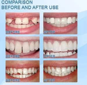 Perles de réparation temporaire des dents de qualité alimentaire, sans danger, non toxique et inoffensif, dents cassées, matériau de remplissage <span class=keywords><strong>dentaire</strong></span>, 20g - Product Image 6