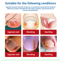 Autocollants pour ongles en forme de U, élastiques, beiges, pour les ongles incarnés |   Patchs orthopédiques ajustables sans colle pour manucure