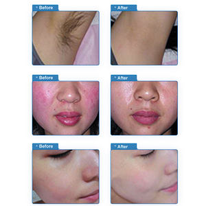 Ipl Machine <span class=keywords><strong>Prix</strong></span> <span class=keywords><strong>Épilation</strong></span> au laser avec refroidissement IPL Photon Skin Beauty pour la maison - Product Image 5