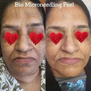 Microneedling Naturale Bio con Spugne Marine per Rimozione di Punti Neri, Acne e Pigmentazione, Peeling con Alghe e Spicole di Spongilla - Product Image 4