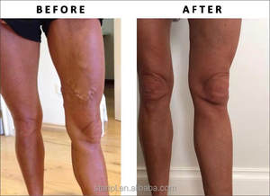 Máquina Médica Láser Nd Yag de 980nm + 1470nm EVLT - Portátil de Alta Potencia <span class=keywords><strong>para</strong></span> la Eliminación de Venas Varicosas y <span class=keywords><strong>Tratamiento</strong></span> Vascular Eficiente - Product Image 5