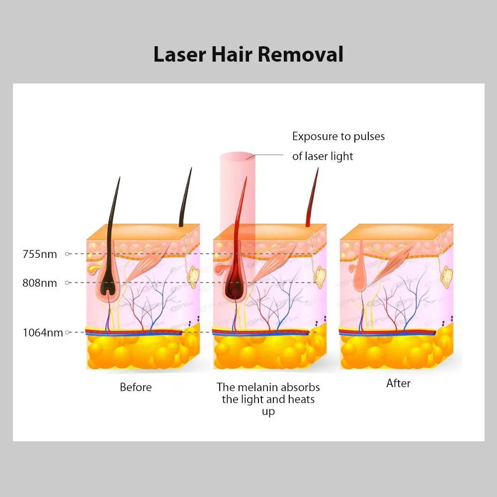 UNTLASER Diode laser 808nm épilation du corps et du visage avec système de refroidissement glace saphir