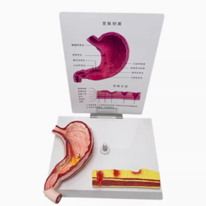 Modelo de Estómago con Estructura Patológica: Gastritis Atrofiada, Úlcera Perforada, Modelo de Sistema Digestivo Humano - Product Image 4