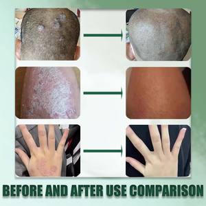 Крем для снятия псориаза для Тела облегчает зуд и устраняет покраснение - Product Image 5