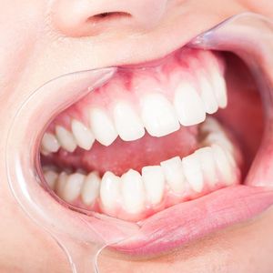 Alat Pembuka Mulut Ortodontik Gigi Tipe C Plastik Retraktor Pipi Alat Pemeriksaan Mulut S/<span class=keywords><strong>M</strong></span>/L Bahan Dokter Gigi - Product Image 2