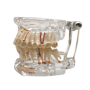 Denti trasparenti per malattie di impianti dentali modello dentista trasparente Standard patologico - Product Image 1