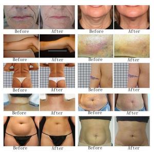 Massaggiatore Portatile 2 in 1 con Rullo a Vuoto e Sfera Interna Verticale 4 in 1 - Product Image 5