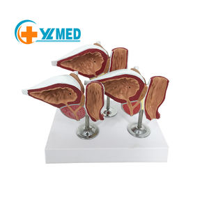 एनाटॉमी पुरुष पैथोलॉजिकल परिवर्तन प्रोस्टेट मॉडल चिकित्सा विज्ञान शैक्षिक आपूर्ति चिकित्सा शिक्षण सहायता - Product Image 1