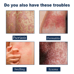Spray Herbal para el Alivio <span class=keywords><strong>de</strong></span> la Picazón, la Desquamation y la Psoriasis, <span class=keywords><strong>Tratamiento</strong></span> para Eczema y Tinea en Manos, Pies y Cuero Cabelludo, Aplicación Corporal - Product Image 4