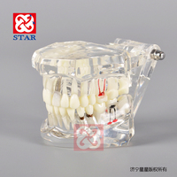 Puente de restauración de dientes extraíbles estándar, modelo Dental, enfermedad de implante, modelo Typodont para dentista que estudia ciencias médicas