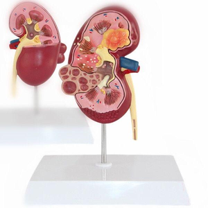 Modelo de Riñón Patológico, Modelo Anatómico Humano para Enseñanza Médica, Demostración de Nefritis, <span class=keywords><strong>Urología</strong></span> Renal, Hospital - Product Image 3
