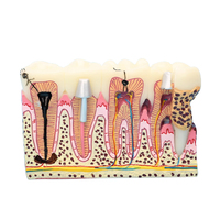 Modèle pathologique dentaire médical modèle anatomique oral dents cariées modèle Dent artificielle