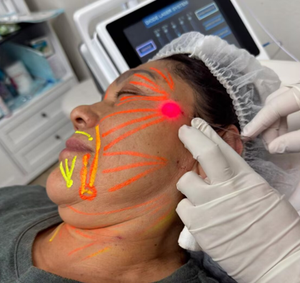 Máquina Láser <span class=keywords><strong>de</strong></span> Estiramiento Cutáneo Endo con Certificación UKCA CE, Lipólisis, Liposucción, Láser <span class=keywords><strong>de</strong></span> Diodo <span class=keywords><strong>de</strong></span> 980nm y 1470nm, Máquina Endoláser <span class=keywords><strong>de</strong></span> Doble Longitud <span class=keywords><strong>de</strong></span> Onda - Product Image 3