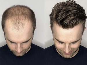 Sistema Capilar Base Australiano de Densidad Media Ligera con Línea de Cabello V-loop, Envío Rápido, Toupee para Hombres - Product Image 6