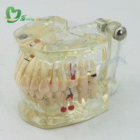 Modelo de Dientes para Patología, Modelo de Estudio Dental