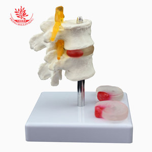 Modelo patológico de columna lumbar FRT038: Modelo humano de dos vértebras lumbares y dos discos intervertebrales enfermos con lesiones lumbares - Product Image 1