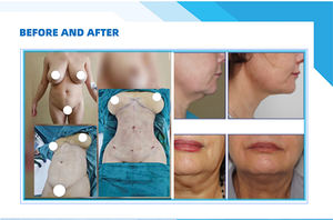 Endolifting 980nm y 1470nm EVLT, Fibra Radial para Venas Endovasculares, Liposucción <span class=keywords><strong>Vaser</strong></span> - Product Image 6